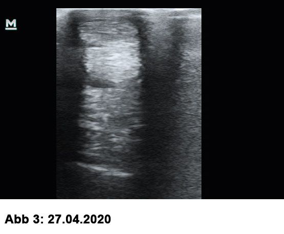 Röntgenbild Beugesehne